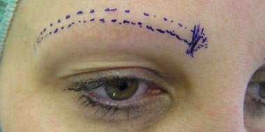 Úplná alopecie